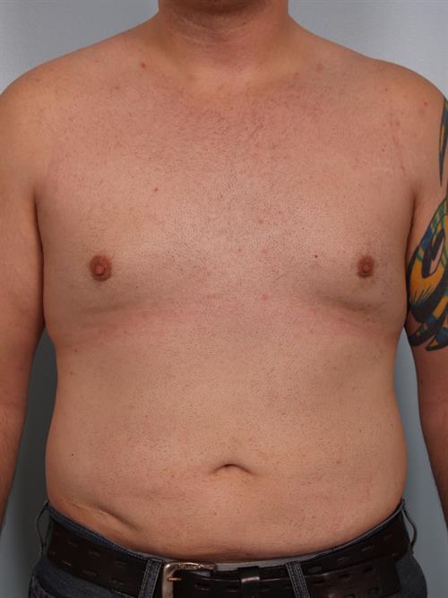 Male Breast/Areola Reduction After Photo | Phoenix and Scottsdale, AZ | Scottsdale Center for Plastic Surgery