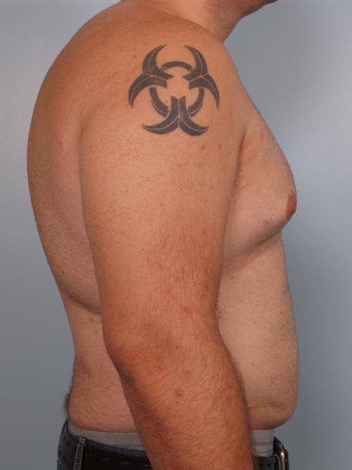Male Breast/Areola Reduction Before Photo | Phoenix and Scottsdale, AZ | Scottsdale Center for Plastic Surgery