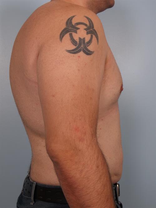 Male Breast/Areola Reduction After Photo | Phoenix and Scottsdale, AZ | Scottsdale Center for Plastic Surgery