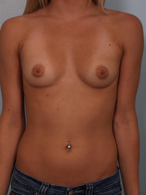 Breast Augmentation Before Photo | Phoenix and Scottsdale, AZ | Scottsdale Center for Plastic Surgery