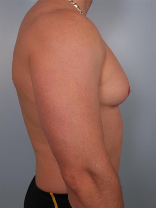Male Breast/Areola Reduction Before Photo | Phoenix and Scottsdale, AZ | Scottsdale Center for Plastic Surgery