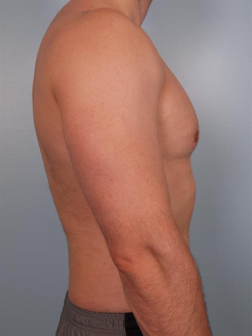 Male Breast/Areola Reduction After Photo | Phoenix and Scottsdale, AZ | Scottsdale Center for Plastic Surgery