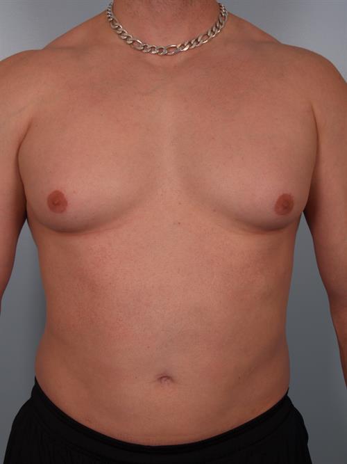 Male Breast/Areola Reduction Before Photo | Phoenix and Scottsdale, AZ | Scottsdale Center for Plastic Surgery