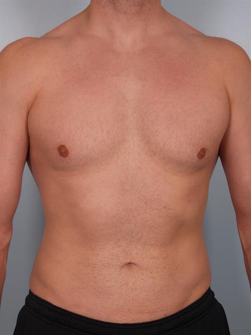 Male Breast/Areola Reduction After Photo | Phoenix and Scottsdale, AZ | Scottsdale Center for Plastic Surgery