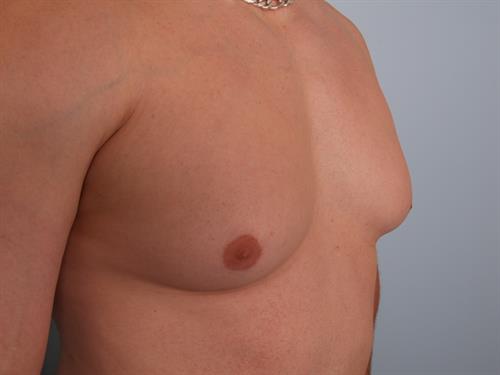 Male Breast/Areola Reduction Before Photo | Phoenix and Scottsdale, AZ | Scottsdale Center for Plastic Surgery