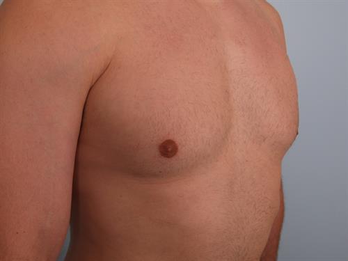 Male Breast/Areola Reduction After Photo | Phoenix and Scottsdale, AZ | Scottsdale Center for Plastic Surgery