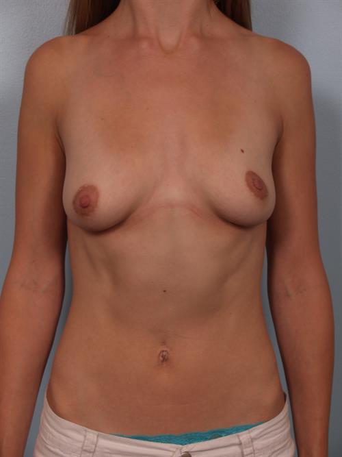 Breast Lift (Mastopexy) Before Photo | Phoenix and Scottsdale, AZ | Scottsdale Center for Plastic Surgery