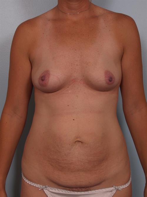Power Assisted Liposuction Before Photo | Phoenix and Scottsdale, AZ | Scottsdale Center for Plastic Surgery