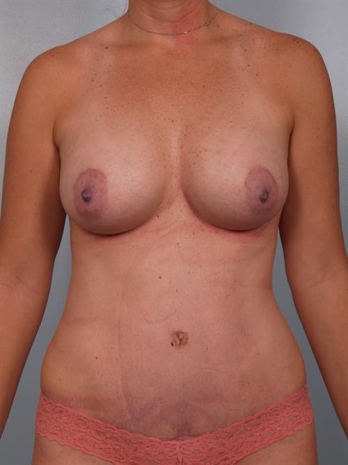 Power Assisted Liposuction After Photo | Phoenix and Scottsdale, AZ | Scottsdale Center for Plastic Surgery