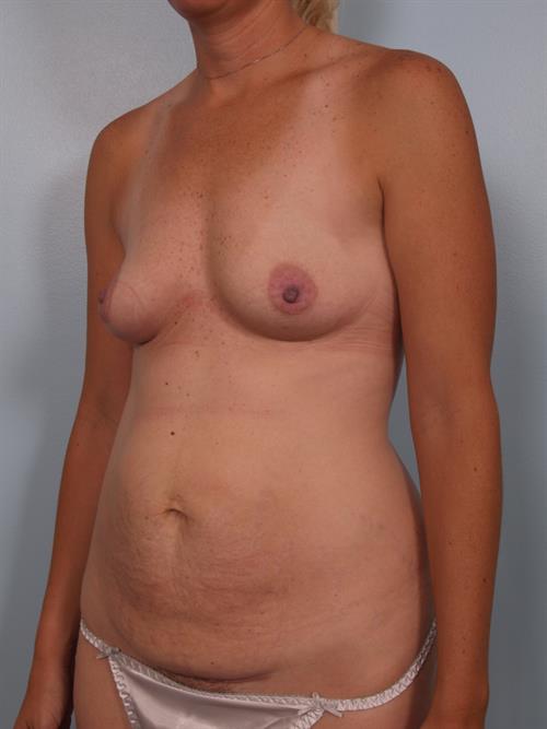 Power Assisted Liposuction Before Photo | Phoenix and Scottsdale, AZ | Scottsdale Center for Plastic Surgery