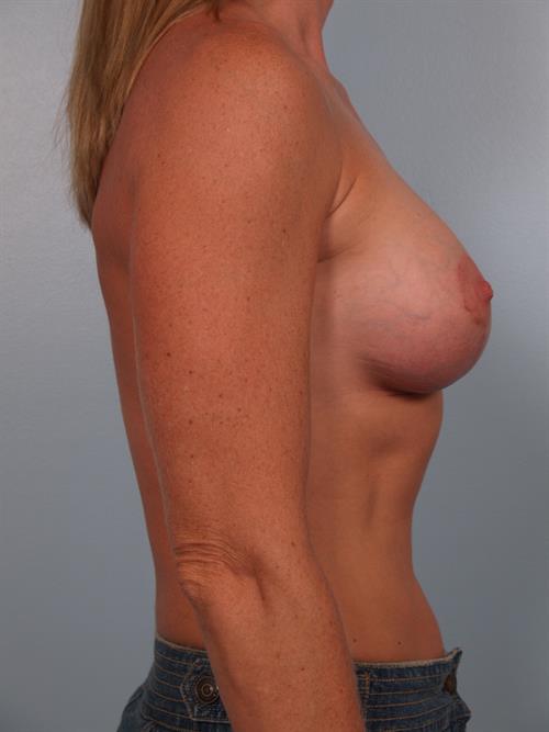 Breast Augmentation After Photo | Phoenix and Scottsdale, AZ | Scottsdale Center for Plastic Surgery
