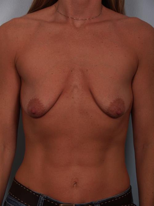 Breast Augmentation Before Photo | Phoenix and Scottsdale, AZ | Scottsdale Center for Plastic Surgery