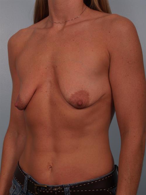 Breast Augmentation Before Photo | Phoenix and Scottsdale, AZ | Scottsdale Center for Plastic Surgery