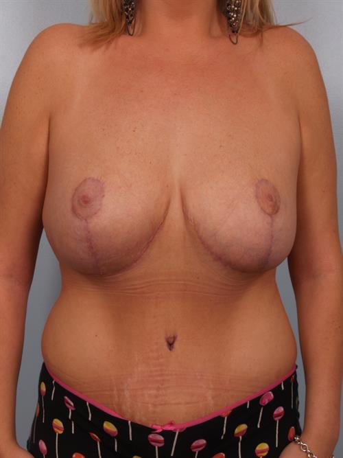 Tummy Tuck After Photo | Phoenix and Scottsdale, AZ | Scottsdale Center for Plastic Surgery