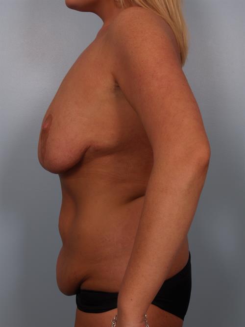 Tummy Tuck Before Photo | Phoenix and Scottsdale, AZ | Scottsdale Center for Plastic Surgery