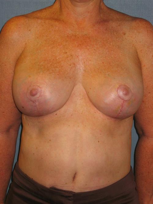 Breast Reduction After Photo | Phoenix and Scottsdale, AZ | Scottsdale Center for Plastic Surgery