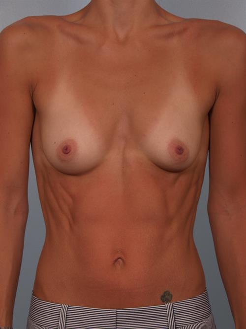 Breast Augmentation Before Photo | Phoenix and Scottsdale, AZ | Scottsdale Center for Plastic Surgery