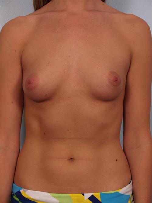 Breast Augmentation Before Photo | Phoenix and Scottsdale, AZ | Scottsdale Center for Plastic Surgery