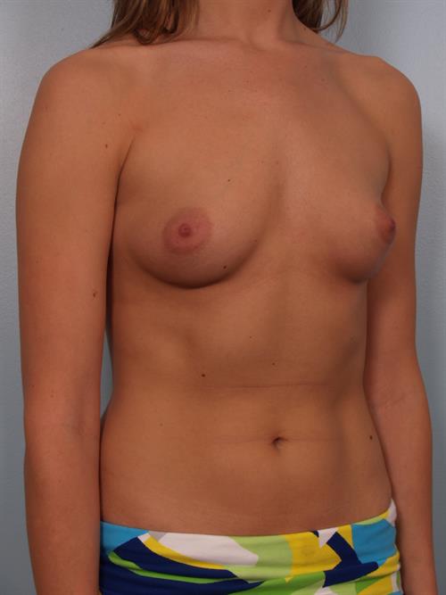 Breast Augmentation Before Photo | Phoenix and Scottsdale, AZ | Scottsdale Center for Plastic Surgery