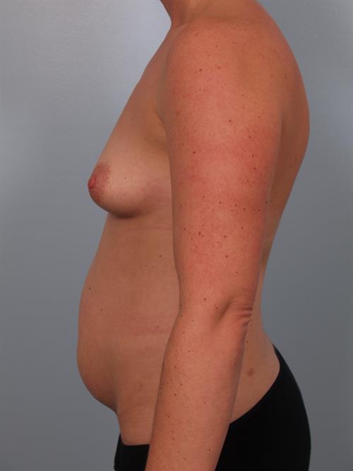 Breast Augmentation Before Photo | Phoenix and Scottsdale, AZ | Scottsdale Center for Plastic Surgery