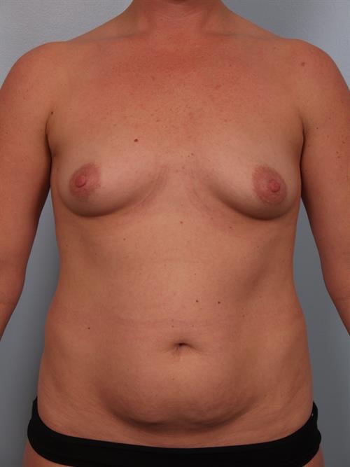 Breast Augmentation Before Photo | Phoenix and Scottsdale, AZ | Scottsdale Center for Plastic Surgery