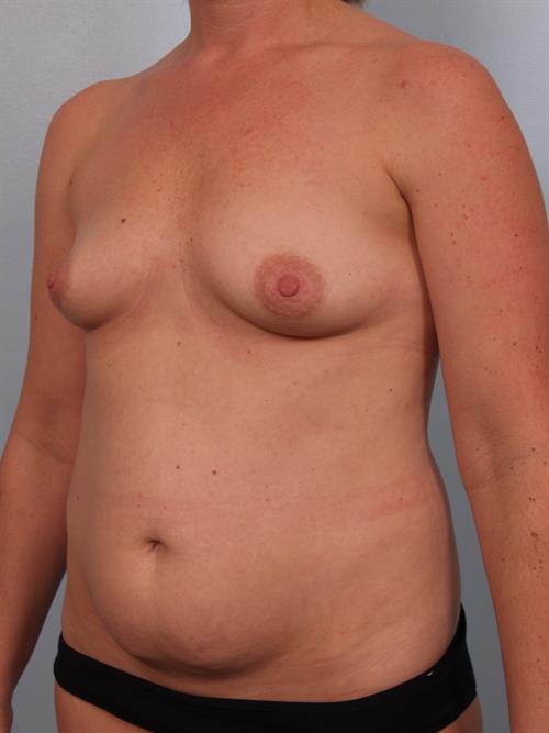 Breast Augmentation Before Photo | Phoenix and Scottsdale, AZ | Scottsdale Center for Plastic Surgery