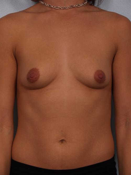 Breast Augmentation Before Photo | Phoenix and Scottsdale, AZ | Scottsdale Center for Plastic Surgery