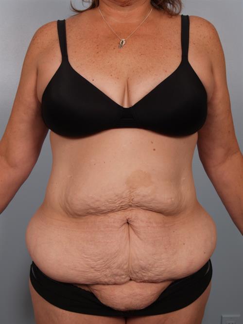 Power Assisted Liposuction Before Photo | Phoenix and Scottsdale, AZ | Scottsdale Center for Plastic Surgery