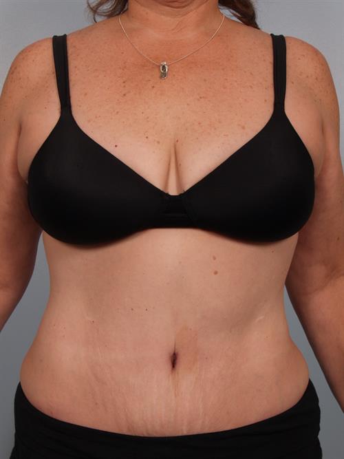 Power Assisted Liposuction After Photo | Phoenix and Scottsdale, AZ | Scottsdale Center for Plastic Surgery