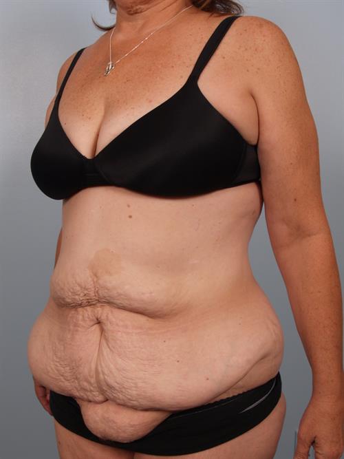 Tummy Tuck Before Photo | Phoenix and Scottsdale, AZ | Scottsdale Center for Plastic Surgery