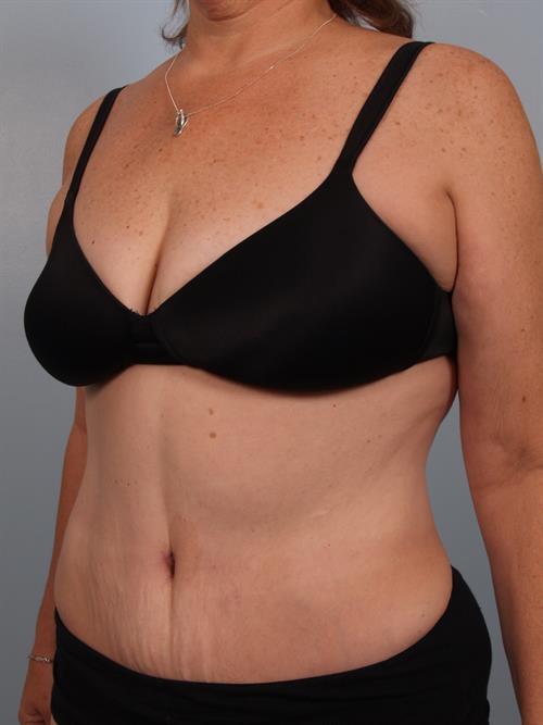 Tummy Tuck After Photo | Phoenix and Scottsdale, AZ | Scottsdale Center for Plastic Surgery