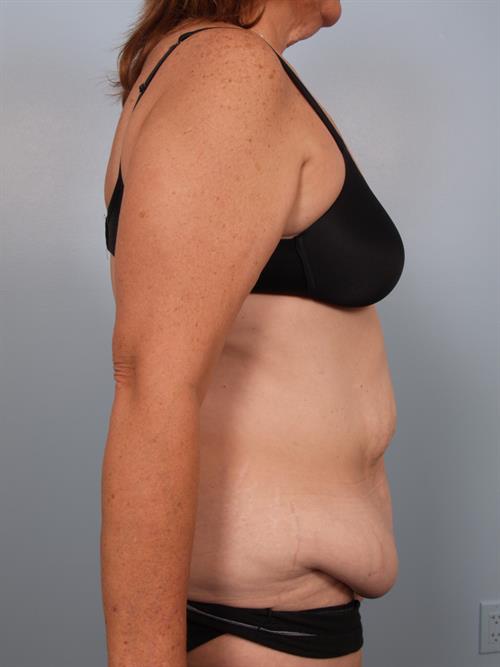 Tummy Tuck Before Photo | Phoenix and Scottsdale, AZ | Scottsdale Center for Plastic Surgery