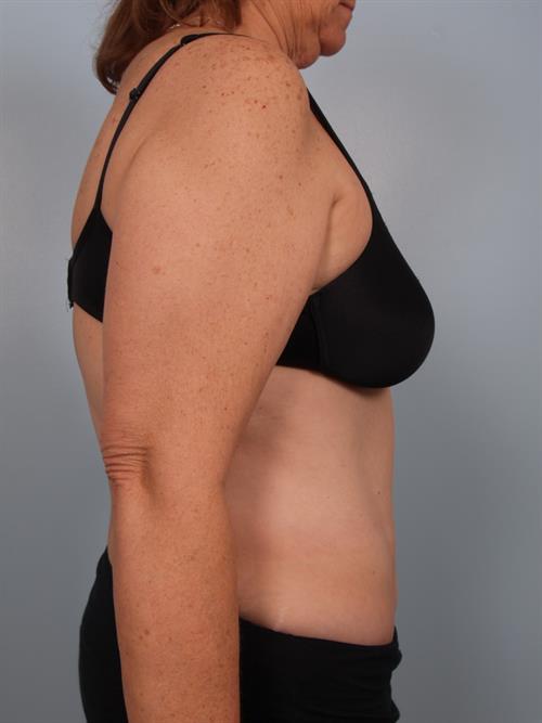 Tummy Tuck After Photo | Phoenix and Scottsdale, AZ | Scottsdale Center for Plastic Surgery