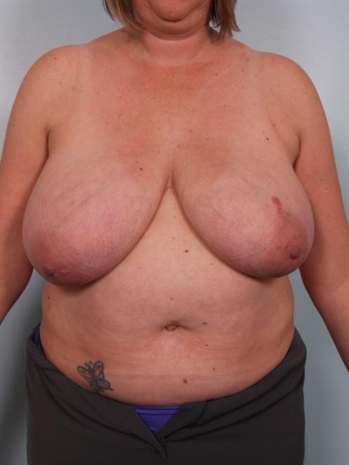 Breast Reduction Before Photo | Phoenix and Scottsdale, AZ | Scottsdale Center for Plastic Surgery