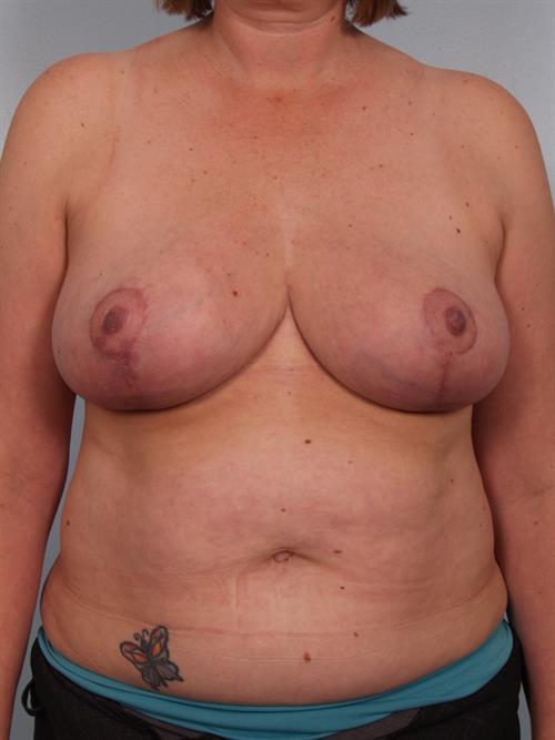 Breast Reduction After Photo | Phoenix and Scottsdale, AZ | Scottsdale Center for Plastic Surgery