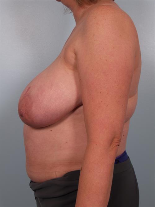 Breast Reduction Before Photo | Phoenix and Scottsdale, AZ | Scottsdale Center for Plastic Surgery