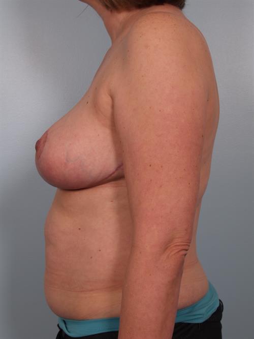 Breast Reduction After Photo | Phoenix and Scottsdale, AZ | Scottsdale Center for Plastic Surgery