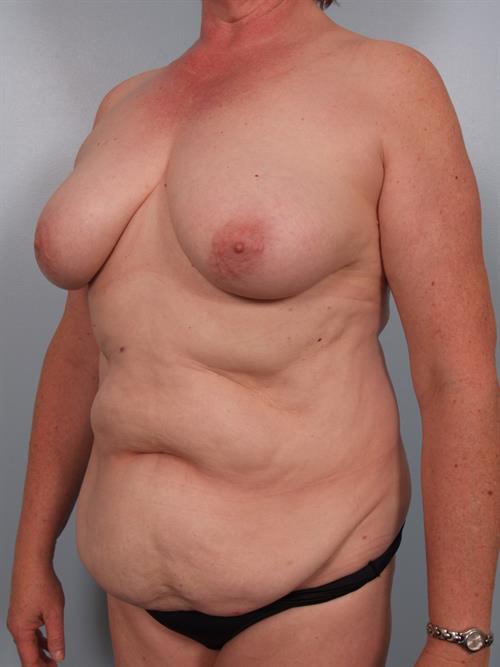 Power Assisted Liposuction Before Photo | Phoenix and Scottsdale, AZ | Scottsdale Center for Plastic Surgery