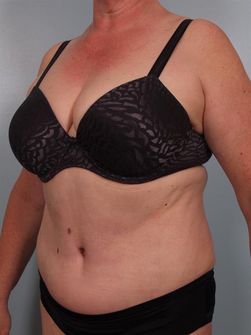Power Assisted Liposuction After Photo | Phoenix and Scottsdale, AZ | Scottsdale Center for Plastic Surgery