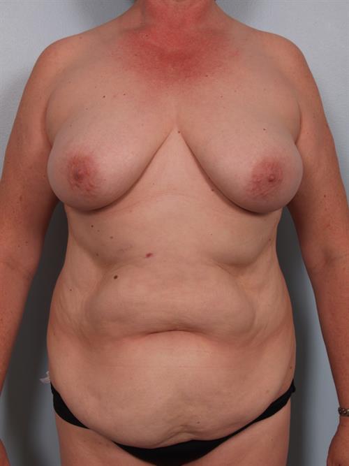 Power Assisted Liposuction Before Photo | Phoenix and Scottsdale, AZ | Scottsdale Center for Plastic Surgery