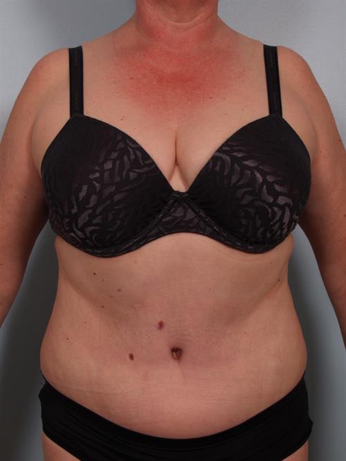 Power Assisted Liposuction After Photo | Phoenix and Scottsdale, AZ | Scottsdale Center for Plastic Surgery