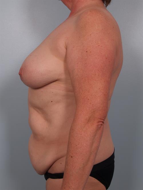 Power Assisted Liposuction Before Photo | Phoenix and Scottsdale, AZ | Scottsdale Center for Plastic Surgery