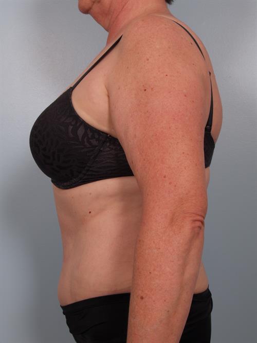 Power Assisted Liposuction After Photo | Phoenix and Scottsdale, AZ | Scottsdale Center for Plastic Surgery