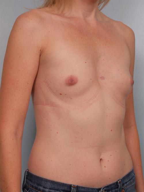 Breast Augmentation Before Photo | Phoenix and Scottsdale, AZ | Scottsdale Center for Plastic Surgery