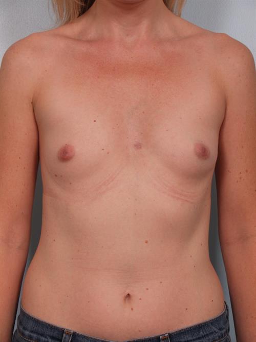 Breast Augmentation Before Photo | Phoenix and Scottsdale, AZ | Scottsdale Center for Plastic Surgery
