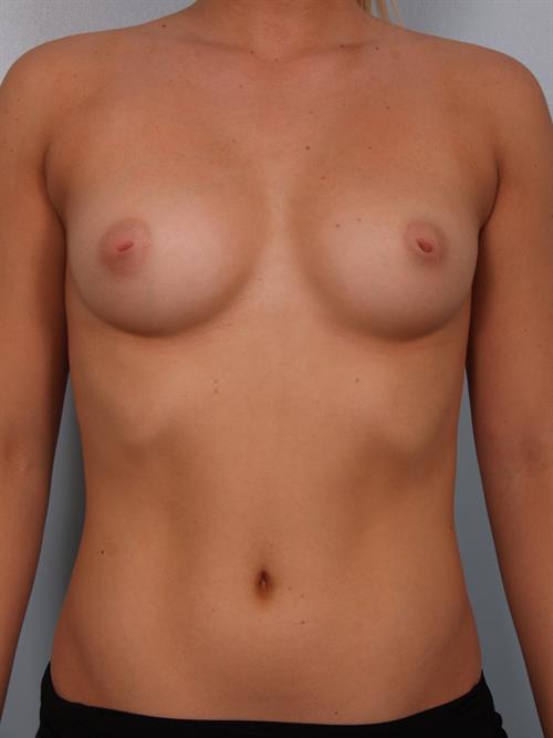 Nipple/Areolar Surgery Before Photo | Phoenix and Scottsdale, AZ | Scottsdale Center for Plastic Surgery