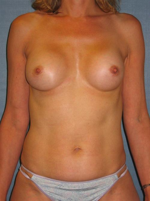 Revision Breast Surgery Before Photo | Phoenix and Scottsdale, AZ | Scottsdale Center for Plastic Surgery