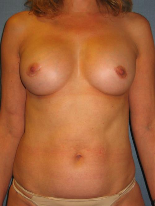 Revision Breast Surgery After Photo | Phoenix and Scottsdale, AZ | Scottsdale Center for Plastic Surgery