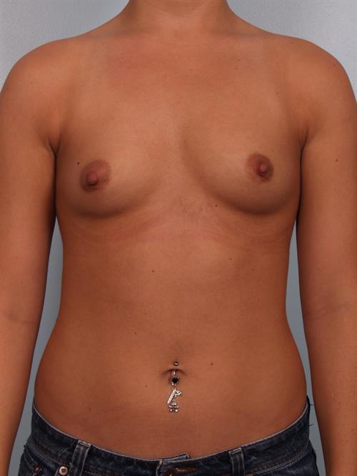 Breast Augmentation Before Photo | Phoenix and Scottsdale, AZ | Scottsdale Center for Plastic Surgery