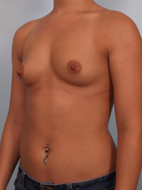 Breast Augmentation Before Photo | Phoenix and Scottsdale, AZ | Scottsdale Center for Plastic Surgery